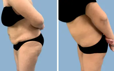 Before and After